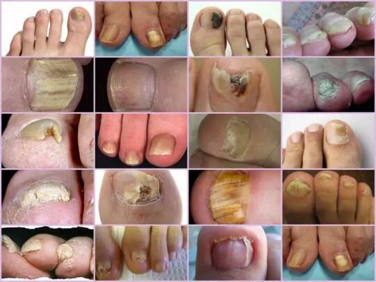 Különböző lokalizáció onychomycosis a körömön