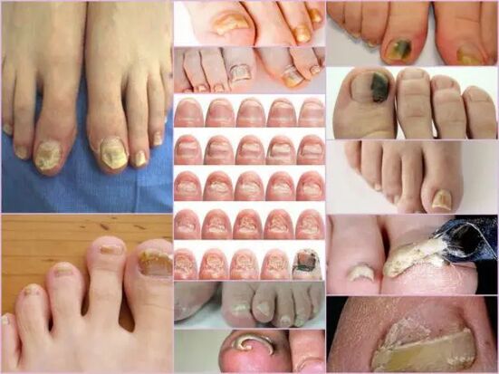 Onychomycosis fajtái